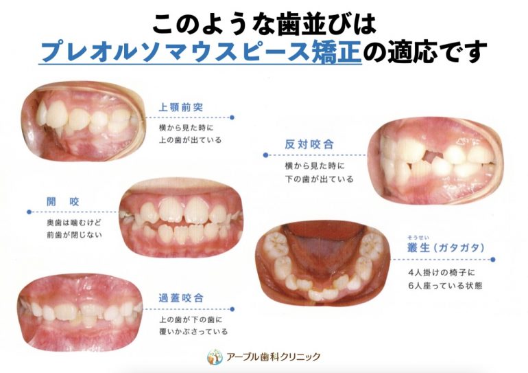 プレオルソマウスピース矯正は歯のガタガタ・出っ歯・反対咬合・開咬に対応しています | アーブル歯科クリニック